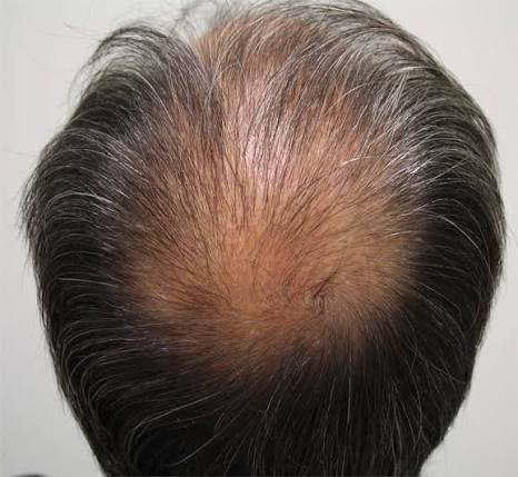 Alopecia androgenética inicial