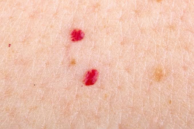Angiomas rubí (puntos rubí)