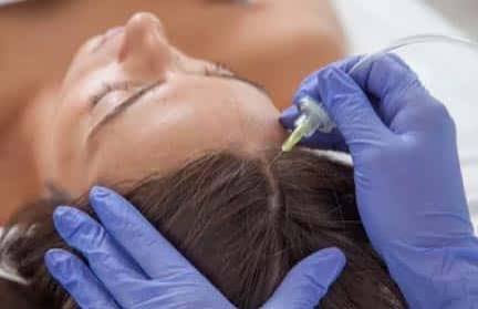 Carboxiterapia capilar