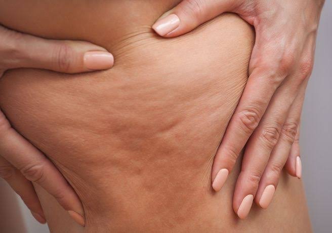 Celulitis