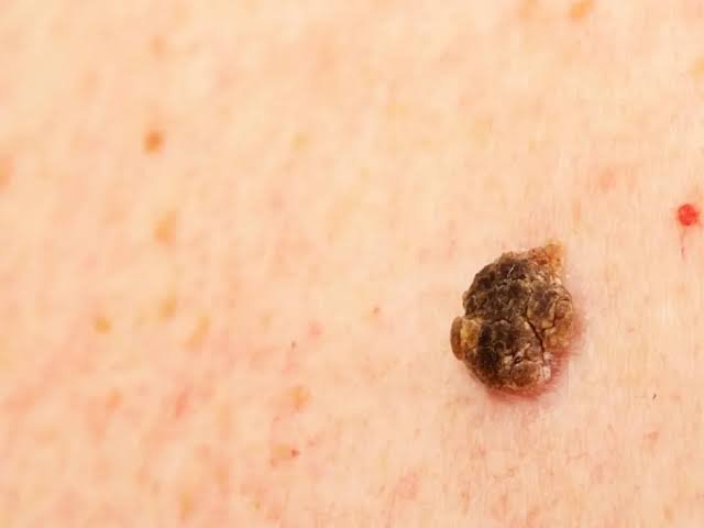 Queratosis seborreicas