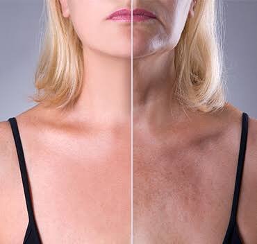 Rejuvenecimiento de cuello