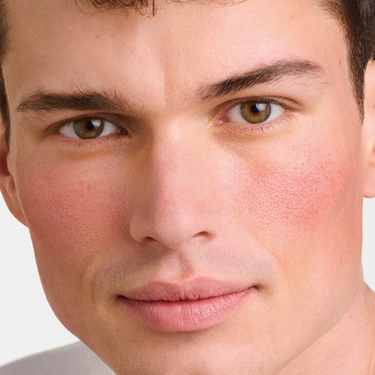 Rosácea